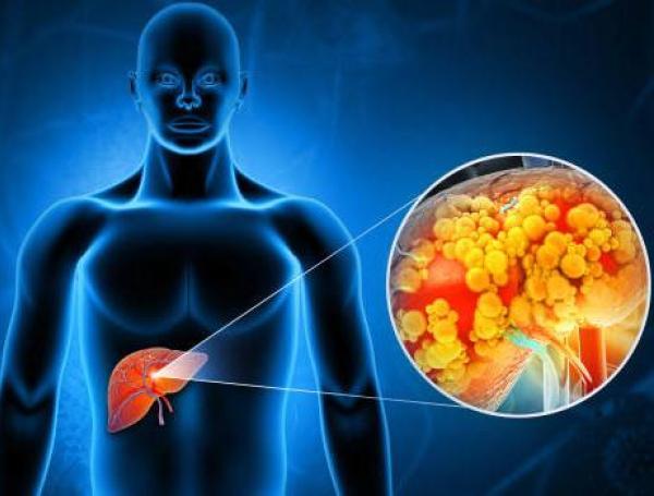Toma nota: dos síntomas del cáncer de hígado que se pueden identificar mientras estás en el baño